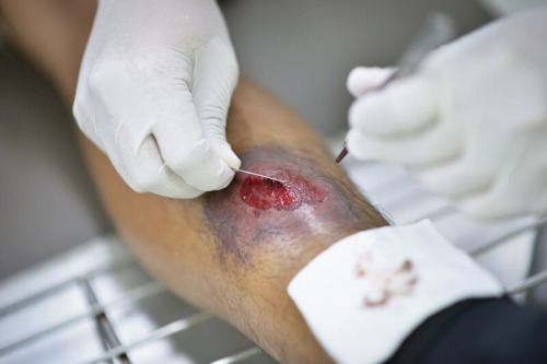 Global Wound Care market