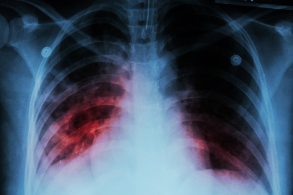 Global Tuberculosis (TB) Drugs Market, tuberculosis market